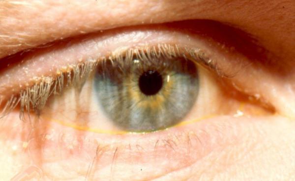 لکه های زرد چشم نشانه اولیه کدام بیماری است؟
