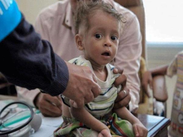 یونیسف: هر 10 دقیقه یک کودک یمنی می میرد، بیش از 540 هزار کودک زیر پنج سال در یمن به سوءتغذیه حاد و تهدیدکننده مبتلا هستند